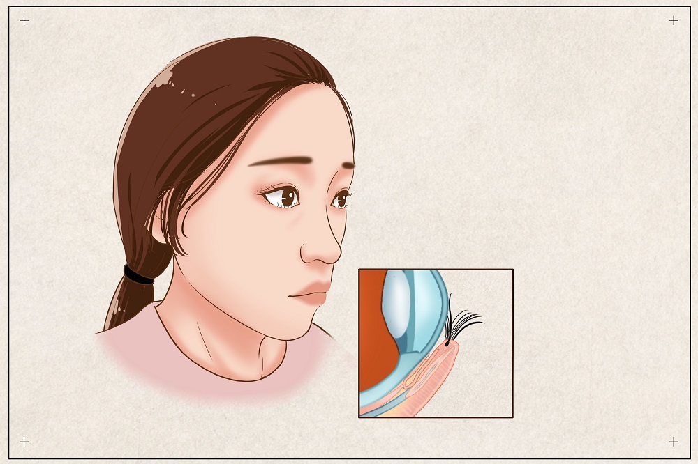 倒睫會(huì)自己好嗎？